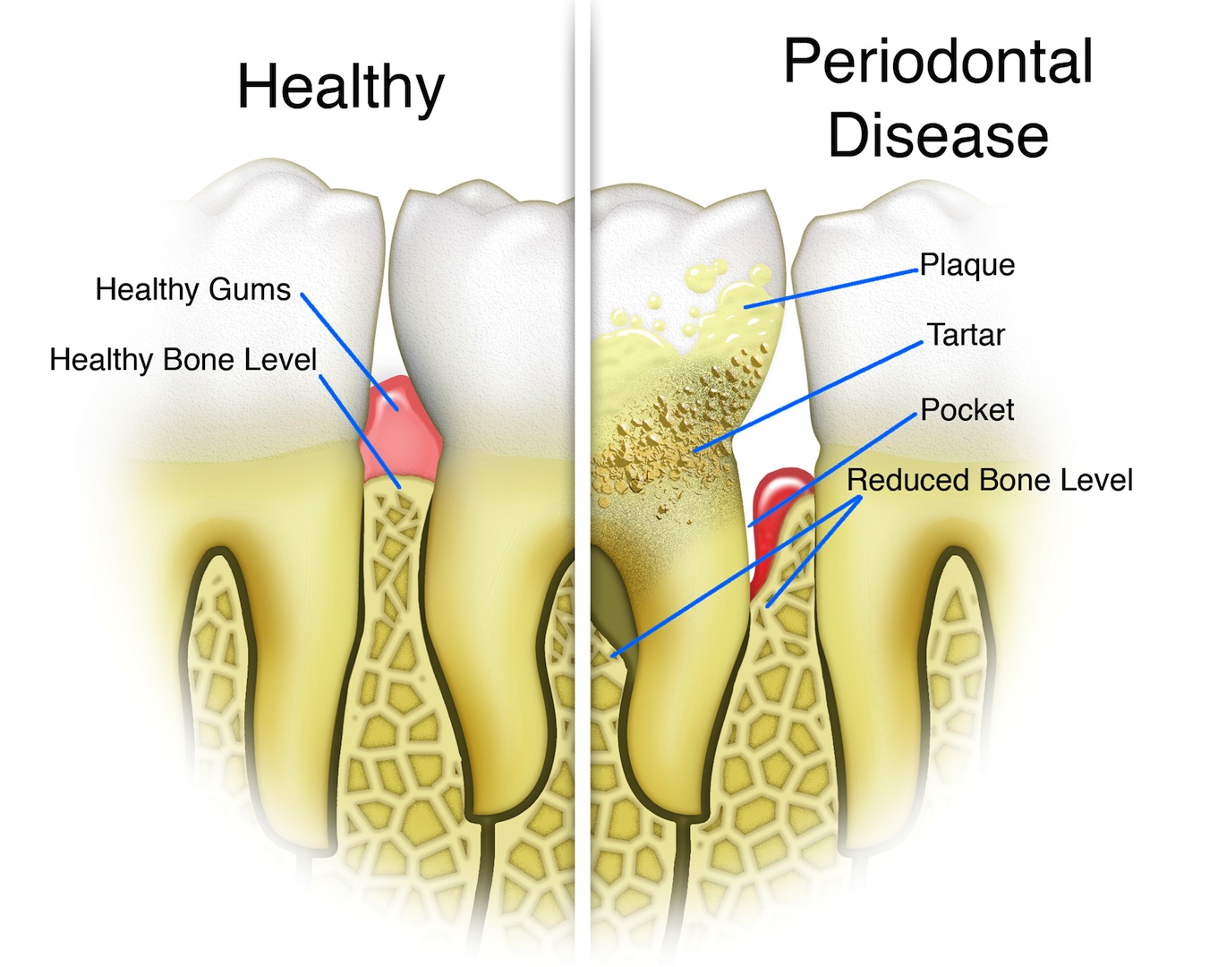 Gum disease can lead to bone loss and eventual tooth loss.